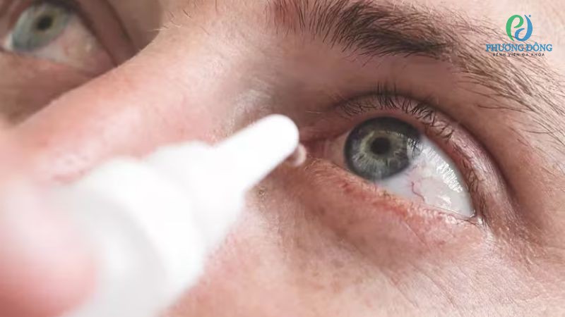Chủ động phòng tránh nguy cơ hình thành sạn vôi ở mắt