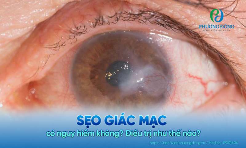 Sẹo giác mạc có nguy hiểm không? Điều trị như thế nào?