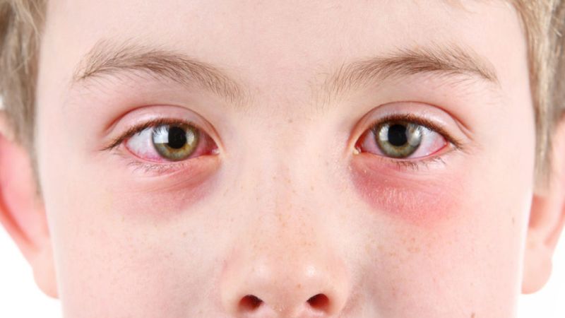 Nhiễm trùng mắt cũng có thể gây ra sẹo ở giác mạc