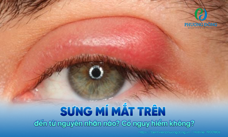 Sưng mí mắt trên đến từ nguyên nhân nào? Có nguy hiểm không?