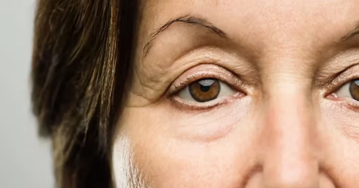 Quá trình lão hóa cũng có thể khiến mí mắt trên bị sưng