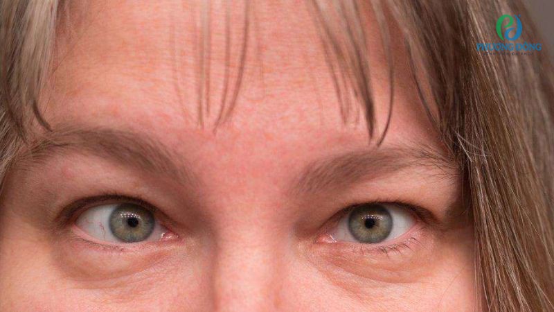 Tật khúc xạ mắt có nguy hiểm không? Nhược thị là một trong những tật khúc xạ nguy hiểm