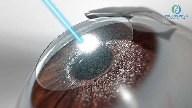 Phẫu thuật LASIK tật khúc xạ mắt tại Bệnh viện Đa khoa Phương Đông