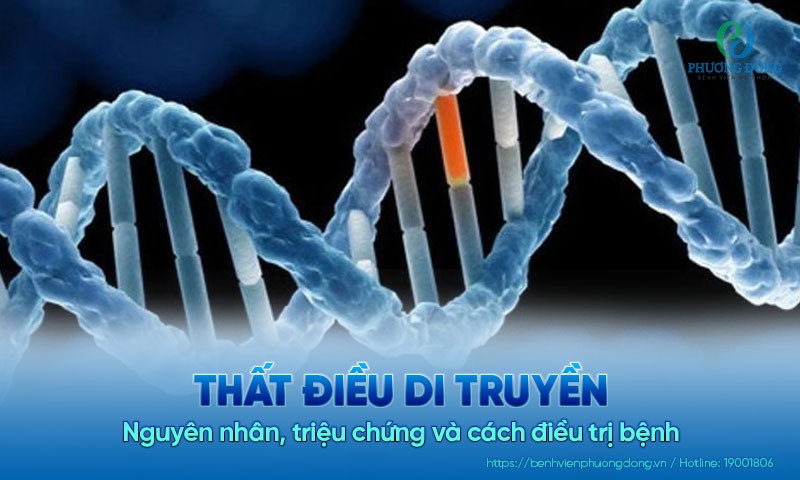 Thất điều di truyền là gì? Nguyên nhân, triệu chứng và cách điều trị bệnh