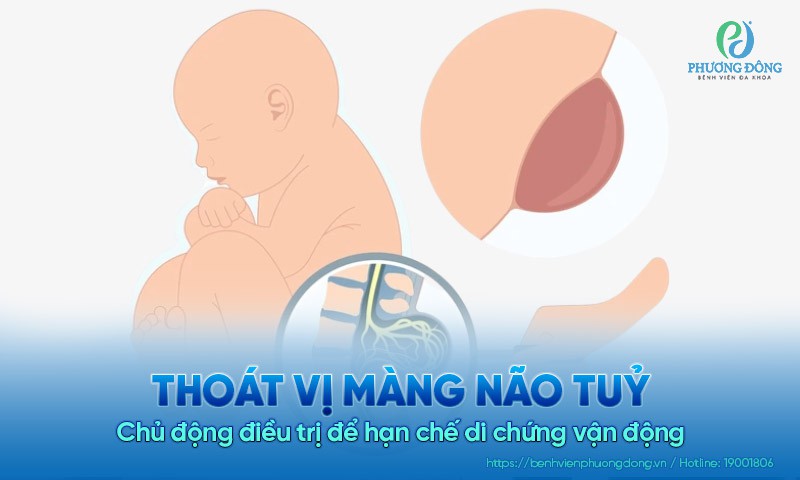 Thoát vị màng não tuỷ: Chủ động điều trị để hạn chế di chứng vận động