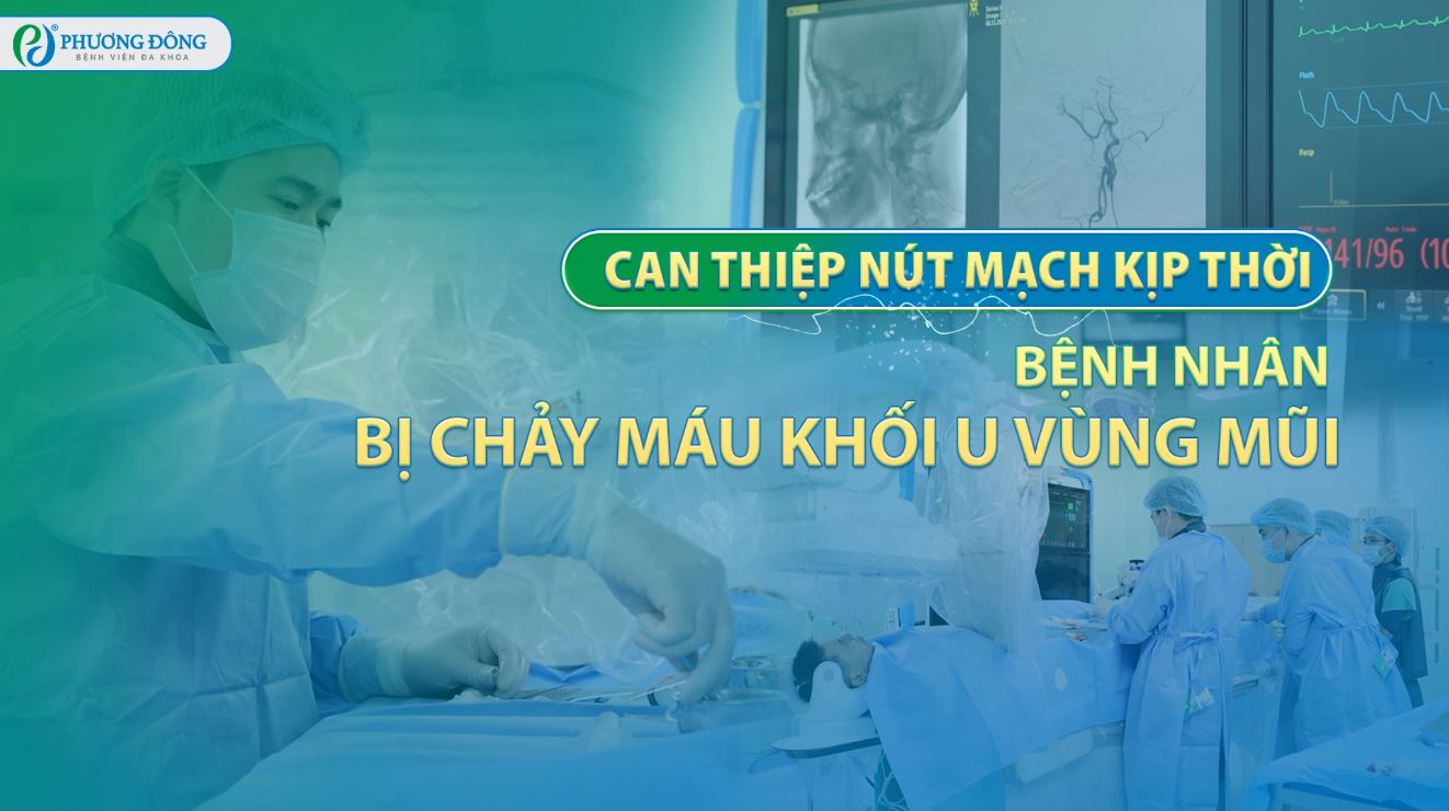 Can thiệp nút mạch kịp thời cho bệnh nhân bị chảy máu khối u vùng mũi
