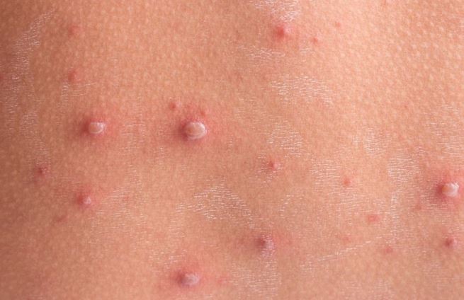 Bệnh thủy đậu và vắc xin phòng bệnh