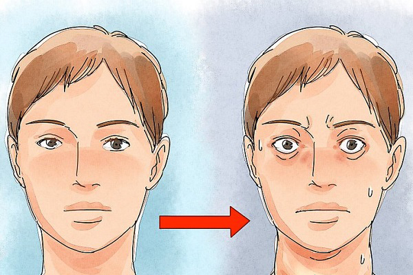 Chia sẻ từ Bác sĩ chuyên khoa: Bệnh BASEDOW (GRAVES)