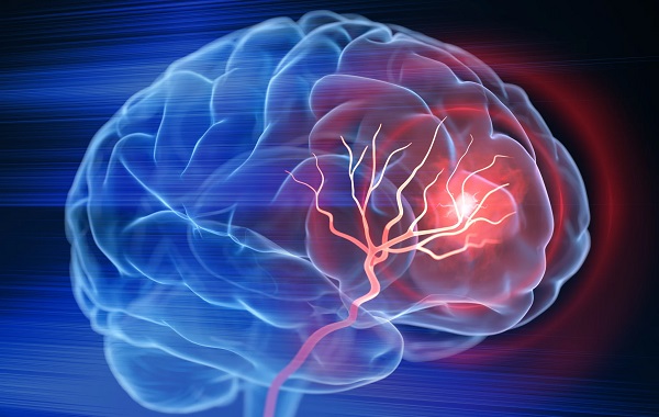 Cơn thiếu máu não thoáng qua (TIA)