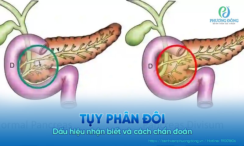 Tụy phân đôi: Dấu hiệu nhận biết và cách chẩn đoán