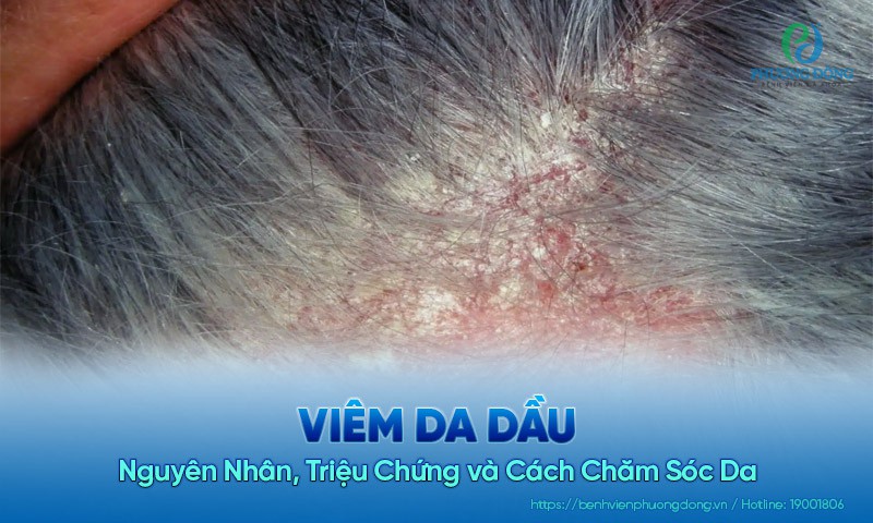 Viêm da dầu: Nguyên nhân, triệu chứng và cách chăm sóc da
