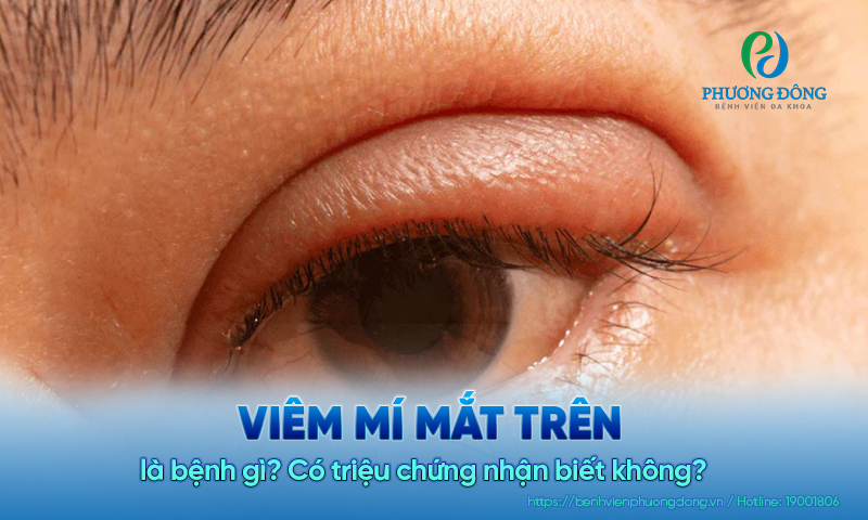 Viêm mí mắt trên là bệnh gì? Có triệu chứng nhận biết không?