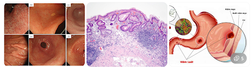 Viêm teo niêm mạc dạ dày- nguy cơ tiềm ẩn không nên chủ qua