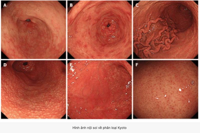 Bảng phân loại Kyoto về nhiễm HP và nguy cơ ung thư dạ dày