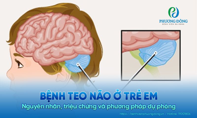 Bệnh teo tiểu não ở trẻ em: Nguyên nhân, triệu chứng và phương pháp dự phòng