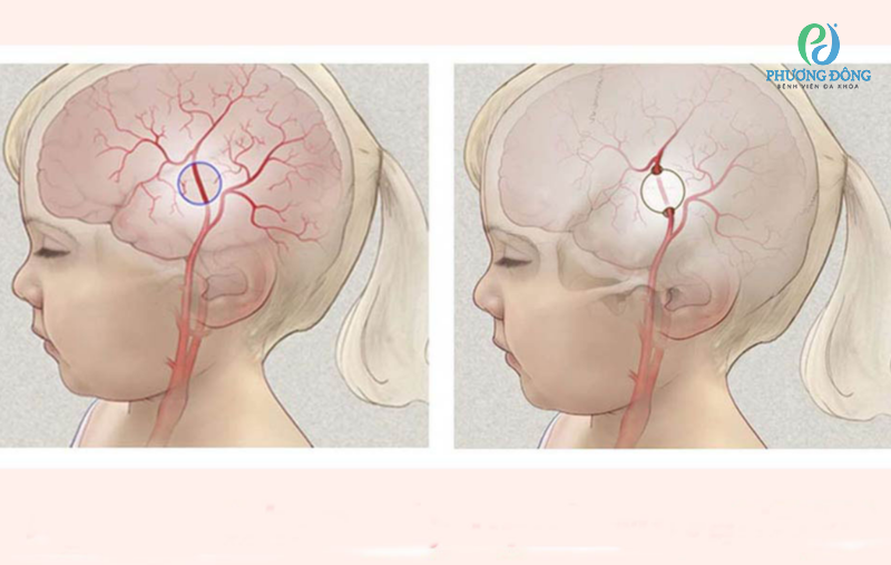Bệnh Moyamoya: Bệnh lý mạch máu não hiếm gặp