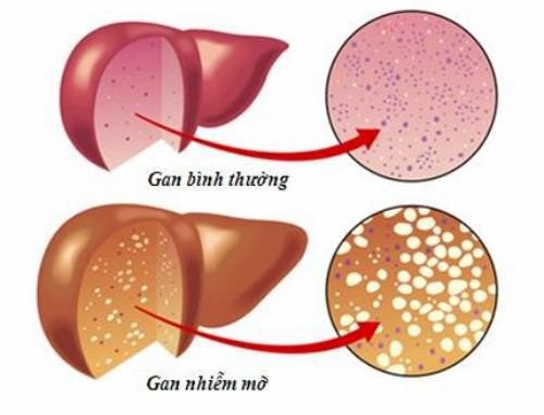 Gan nhiễm mỡ có thể dẫn đến viêm gan, xơ gan