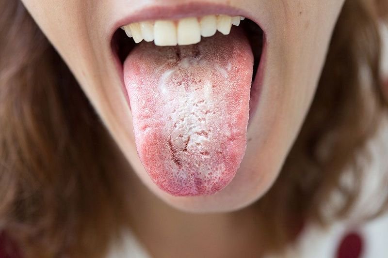 Các triệu chứng đốm trắng trên lưỡi 