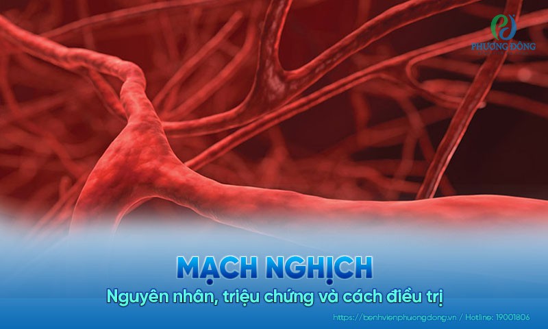 Mạch nghịch: Nguyên nhân, triệu chứng và cách điều trị