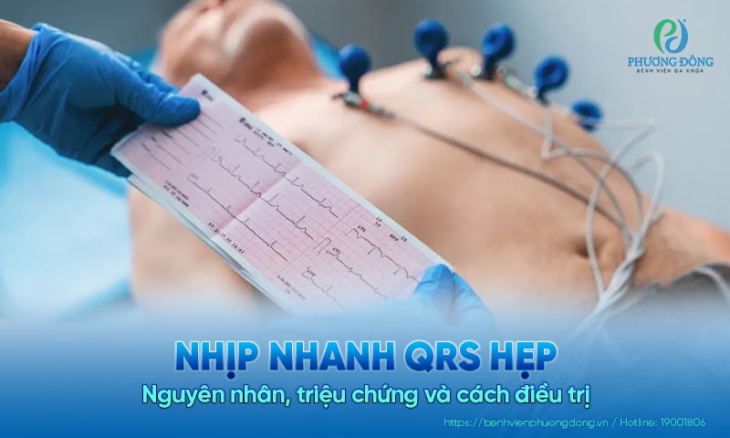 Nhịp nhanh QRS hẹp: Nguyên nhân, triệu chứng và cách điều trị