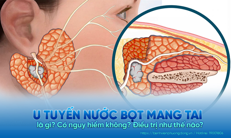 U tuyến nước bọt mang tai là gì? Có nguy hiểm không? Điều trị như thế nào?