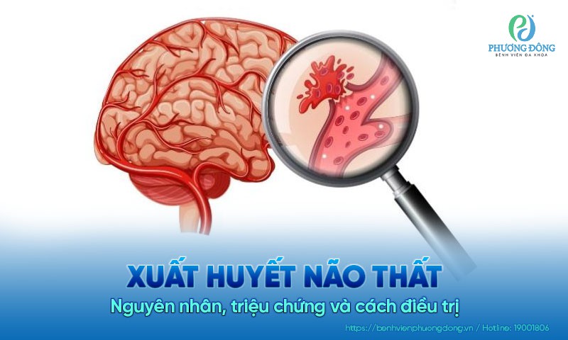 Xuất huyết não thất: Nguyên nhân, triệu chứng và cách điều trị