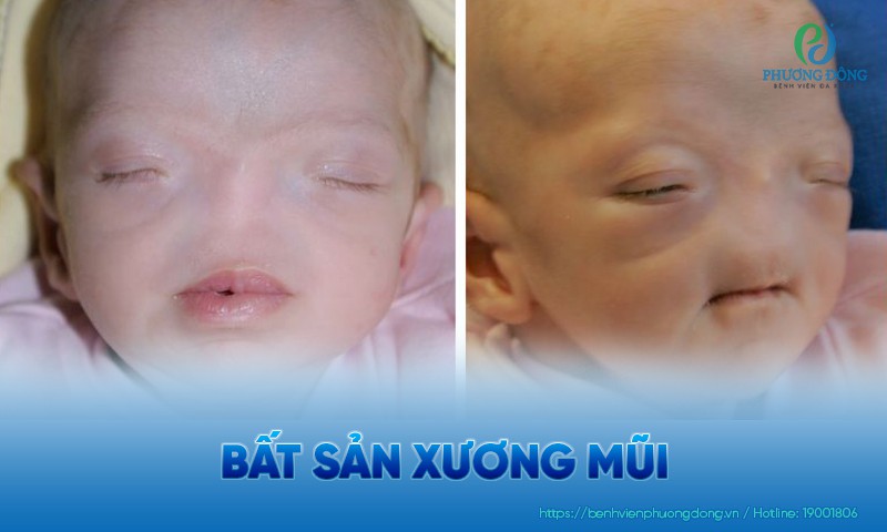 Bất sản xương mũi là gì? Những hệ lụy liên quan đến sức khỏe