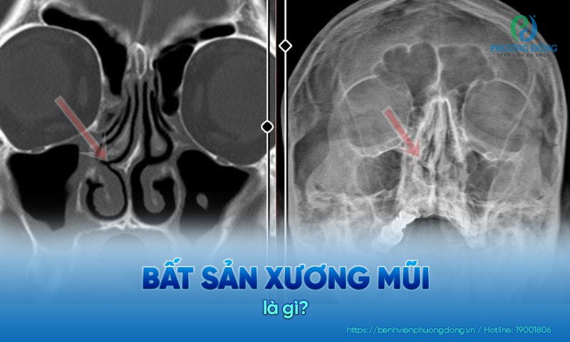 Bất sản xương mũi qua hình ảnh siêu âm
