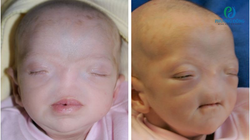 Hội chứng di truyền hoặc các yếu tố bất thường có thể trở thành nguyên nhân gây bệnh