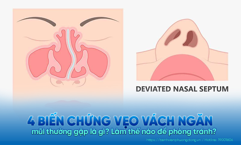 4 Biến chứng của vẹo vách ngăn mũi là gì? Cách phòng tránh?