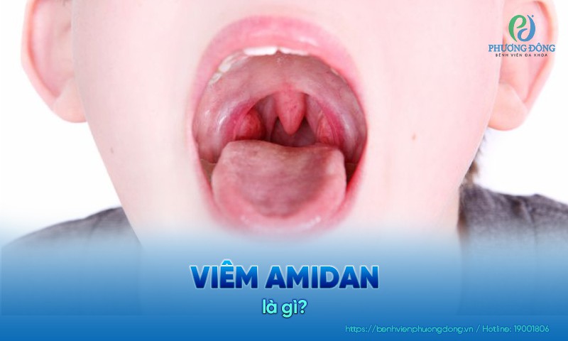 Viêm amidan là tình trạng amidan sưng to, tấy đỏ do virus, vi khuẩn