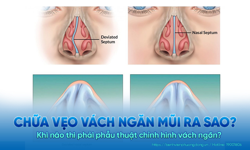 Chữa vẹo vách ngăn mũi như thế nào? Khi nào thì phải phẫu thuật ?