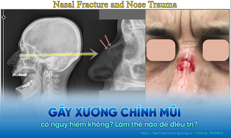 Gãy xương chính mũi có nguy hiểm không? Làm thế nào để điều trị?