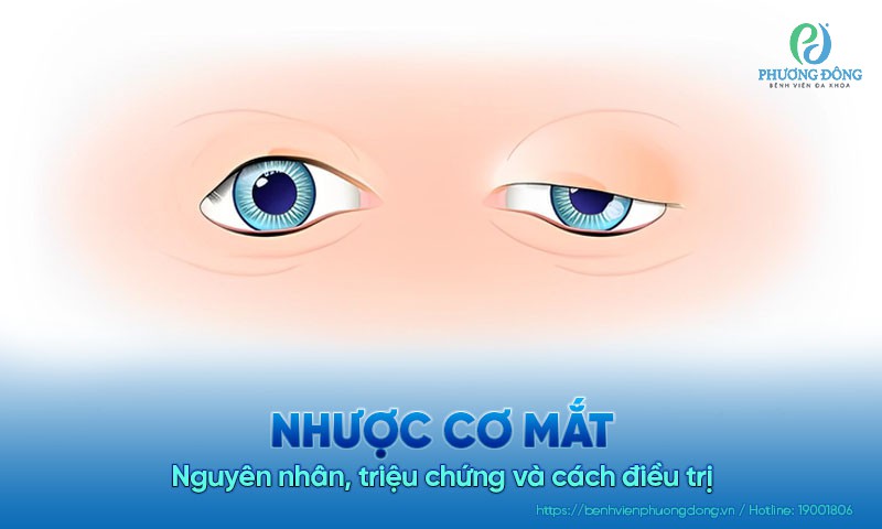 Nhược cơ mắt: Nguyên nhân, triệu chứng và cách điều trị