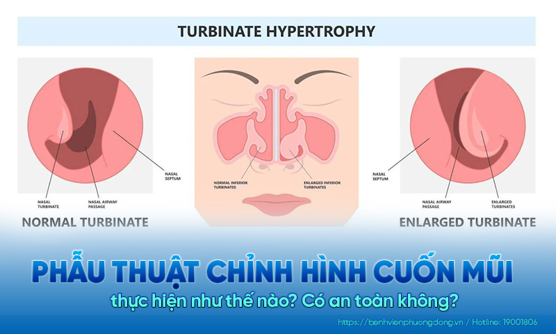 Phẫu thuật chỉnh hình cuốn mũi là gì? Có an toàn không?