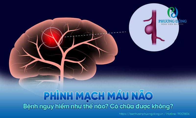 Bệnh phình mạch máu não nguy hiểm như thế nào? Có chữa được không?