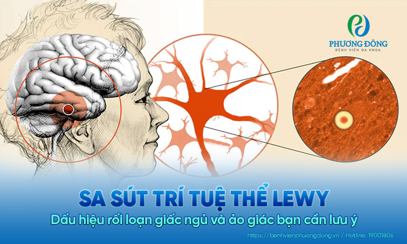 Sa sút trí tuệ thể Lewy: Dấu hiệu rối loạn giấc ngủ và ảo giác cần lưu ý