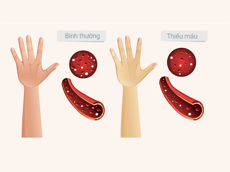 BỆNH THIẾU MÁU THIẾU SẮT