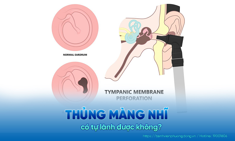 Giải thích chi tiết: Thủng màng nhĩ có tự lành được không?