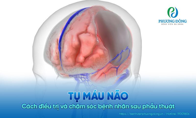 Làm gì khi bị tụ máu não? Cách điều trị và chăm sóc bệnh nhân sau phẫu thuật