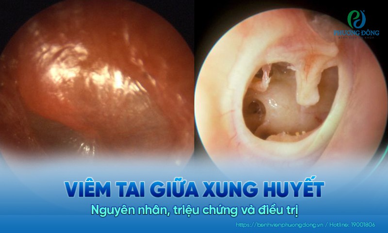 Viêm tai giữa xung huyết: Nguyên nhân, triệu chứng và điều trị