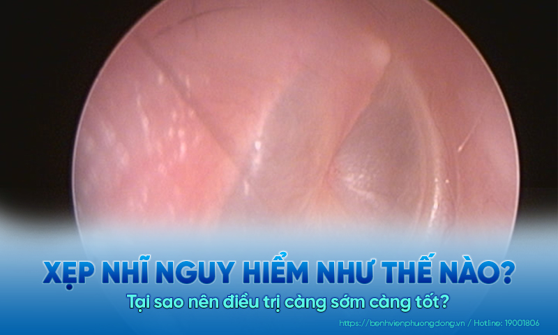 Xẹp nhĩ nguy hiểm như thế nào? Vì sao nên điều trị càng sớm càng tốt?