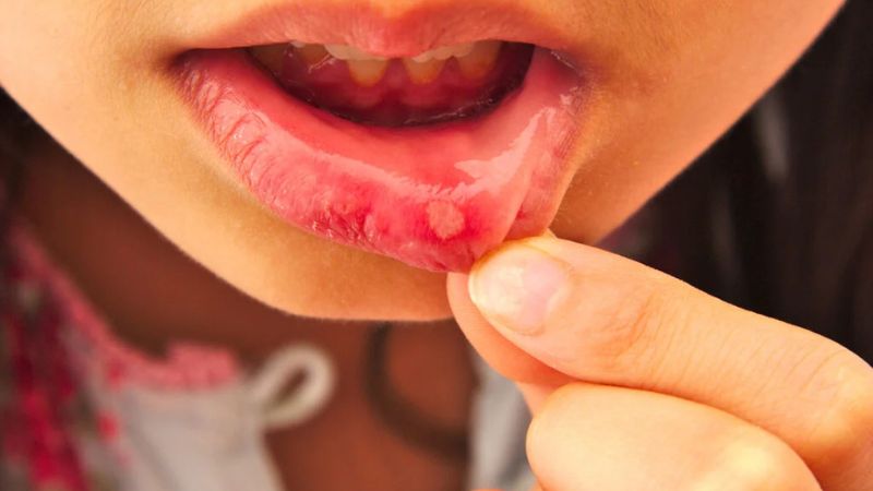 Một số bệnh nhi bị viêm lợi, nhiệt miệng có thể ăn uống kém hơn bình thường