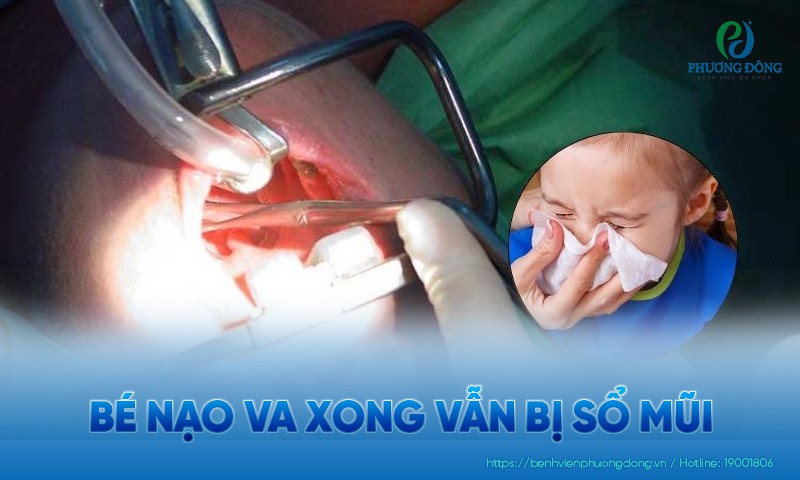 Bé nạo VA xong vẫn bị sổ mũi? Làm sao để khắc phục?