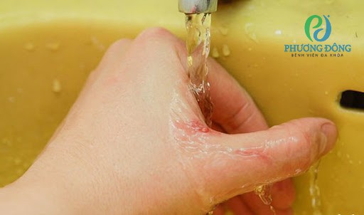 Tuân thủ đúng cách xử lý sau phơi nhiễm để ngăn ngừa bệnh dại