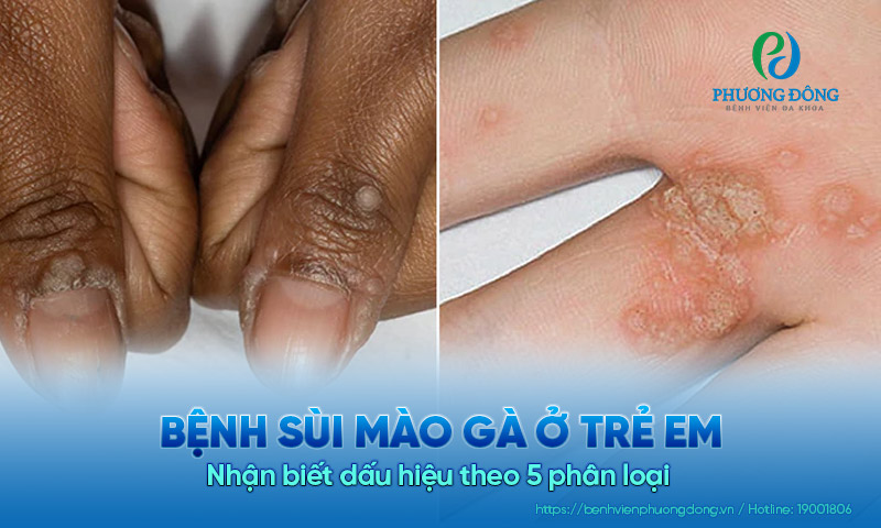 Bệnh sùi mào gà ở trẻ em: Nhận biết dấu hiệu theo 5 phân loại
