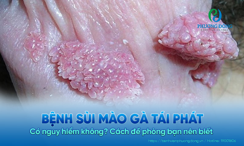 Bệnh sùi mào gà tái phát có nguy hiểm không? Cách đề phòng bạn nên biết