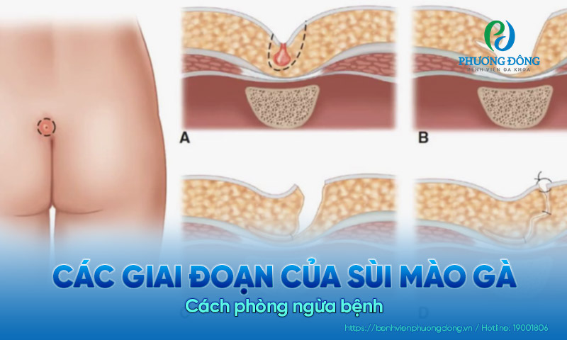 Các giai đoạn sùi mào gà từ nhẹ đến nặng và cách phòng ngừa