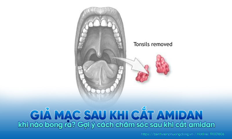 Giả mạc sau khi cắt amidan khi nào bong ra? Gợi ý cách chăm sóc sau khi cắt amidan