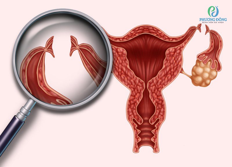 Hiểu đúng về phương pháp triệt sản nữ trong mổ lấy thai